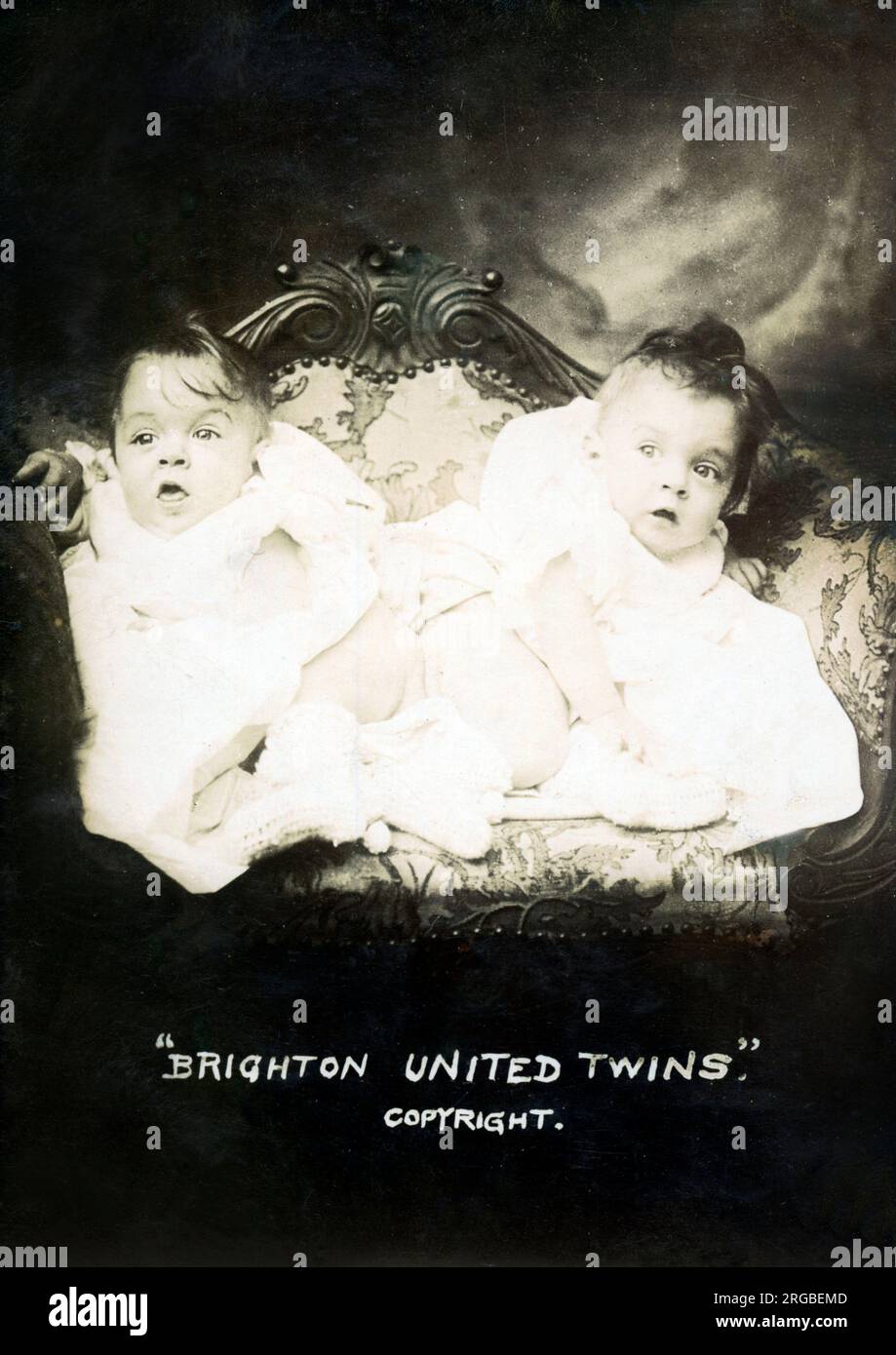 Le 'Brighton United Twins' - famose sorelle congiunte Daisy e Violet Hilton (1908-1969). Le gemelle sono state esposte in Europa da bambini, e hanno fatto un tour negli Stati Uniti, nei circuiti di vaudeville e burlesque negli anni '1920 e '1930 Erano meglio conosciuti per le loro apparizioni cinematografiche in Freaks e la biografia Chained for Life (1951). Foto Stock