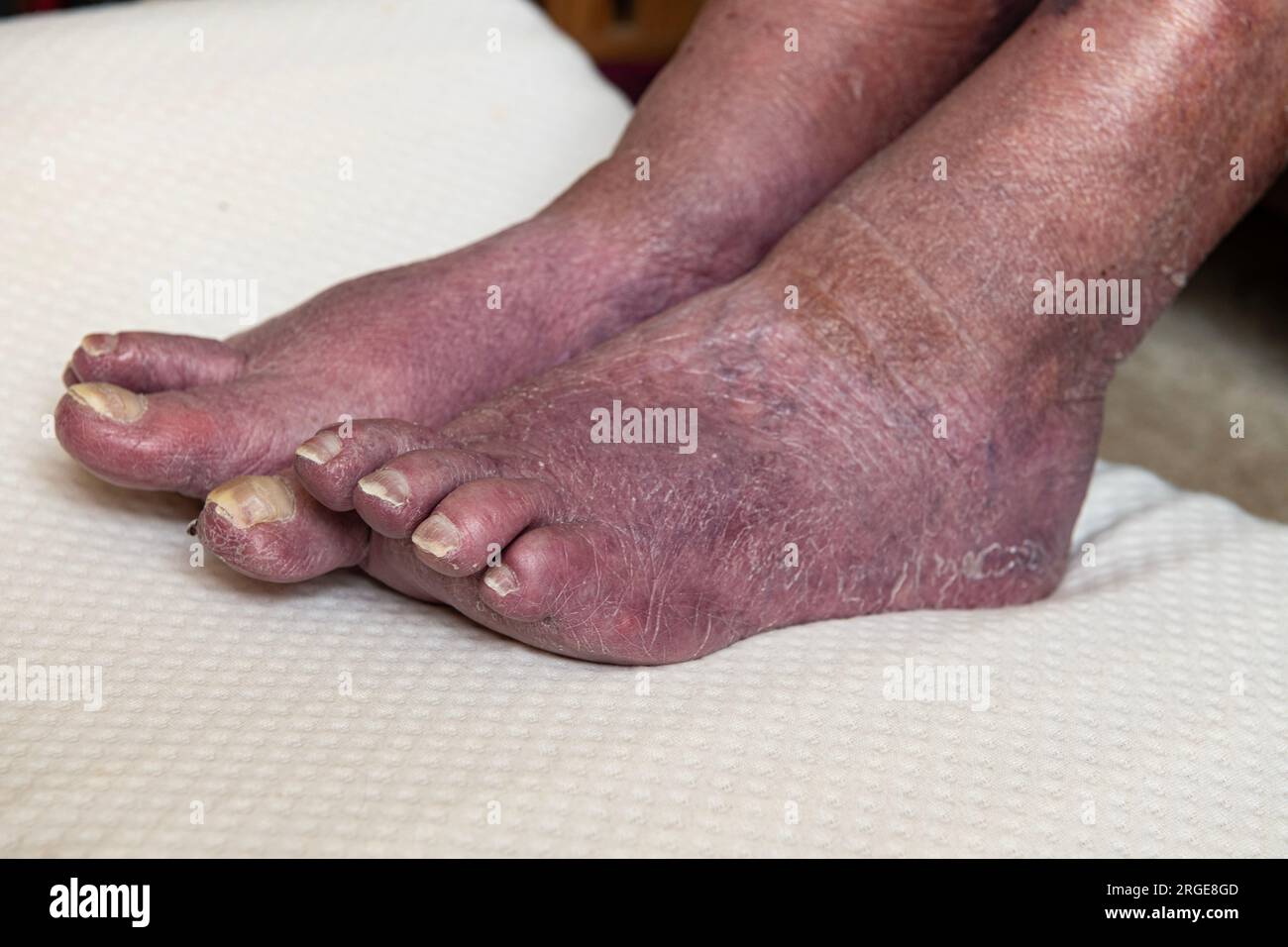 Cattiva circolazione nei piedi delle donne anziane. Foto Stock
