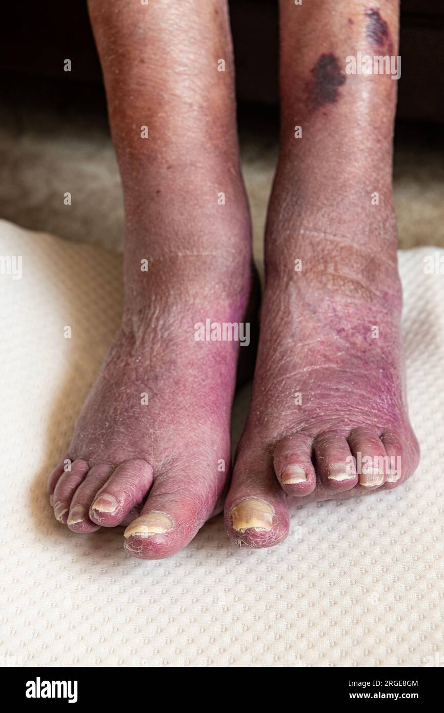 Cattiva ciculazione nei piedi delle donne anziane. Foto Stock
