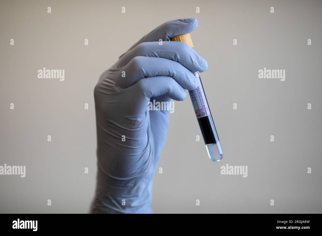 Foto del fascicolo datata 05/06/2020 di un paramedico contenente una provetta contenente un campione di sangue in un programma di test anticorpale per coronavirus presso l'Hollymore Ambulance Hub del West Midlands Ambulance Service di Birmingham. L'aumento dei livelli di zucchero nel sangue potrebbe essere collegato ad un maggiore rischio di malattie cardiache, la ricerca suggerisce. Lo studio ha rilevato che gli uomini e le donne con livelli di zucchero nel sangue aumentati hanno una probabilità maggiore del 30-50% di sviluppare malattie cardiovascolari anche quando questi livelli sono al di sotto della soglia per il diabete. Data di emissione: Giovedì 10 agosto 2023. Foto Stock