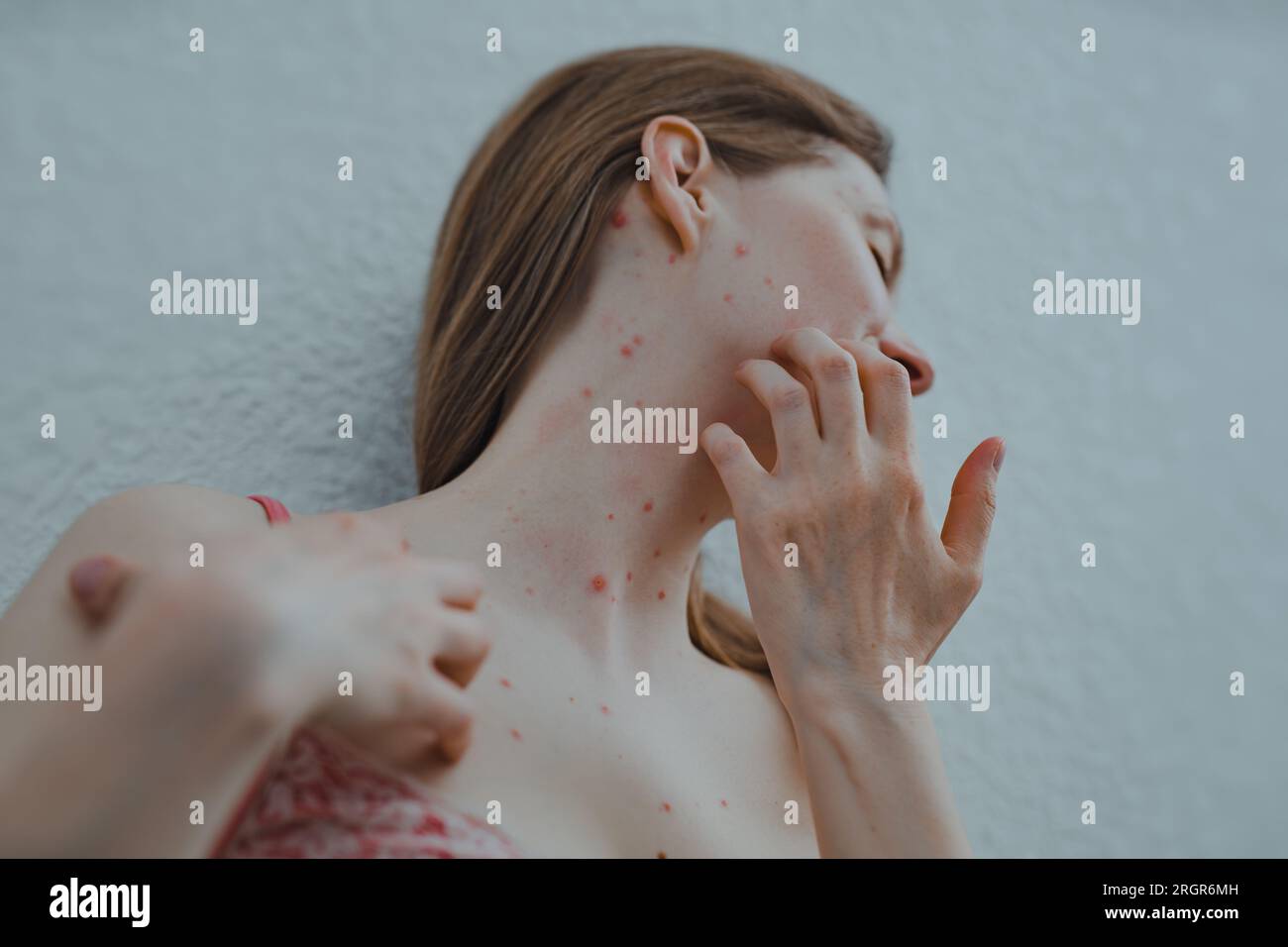 Una donna con la varicella si gratta la pelle Foto Stock