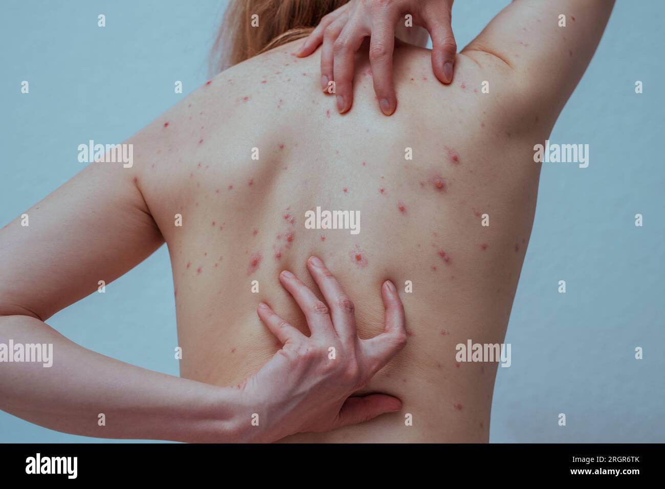 Una donna con la varicella le gratta la schiena Foto Stock