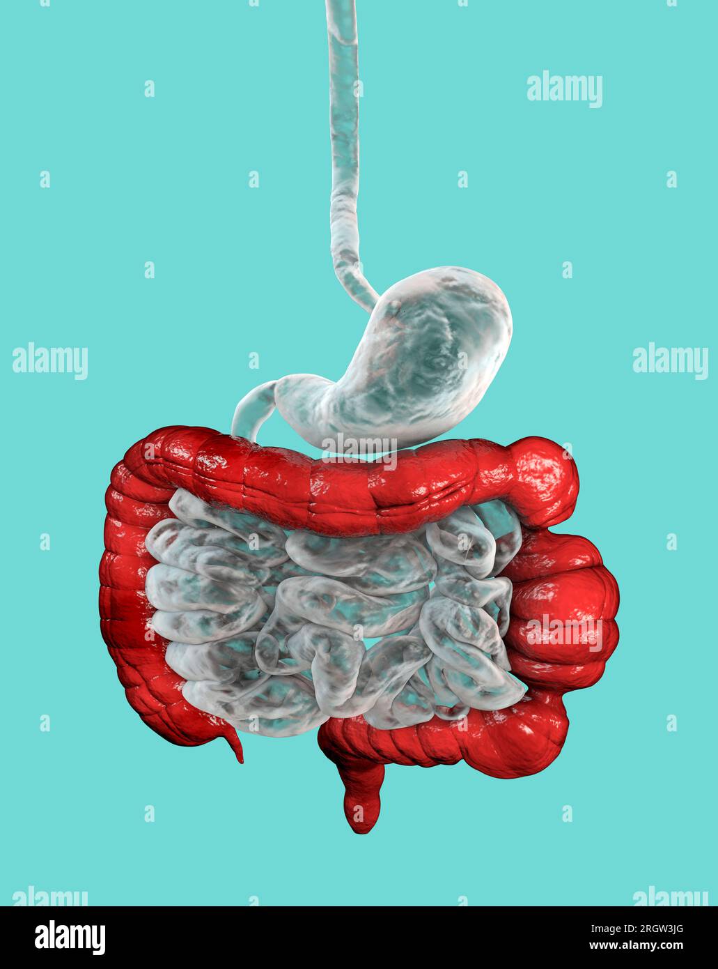 Sindrome dell'intestino irritabile, illustrazione Foto Stock