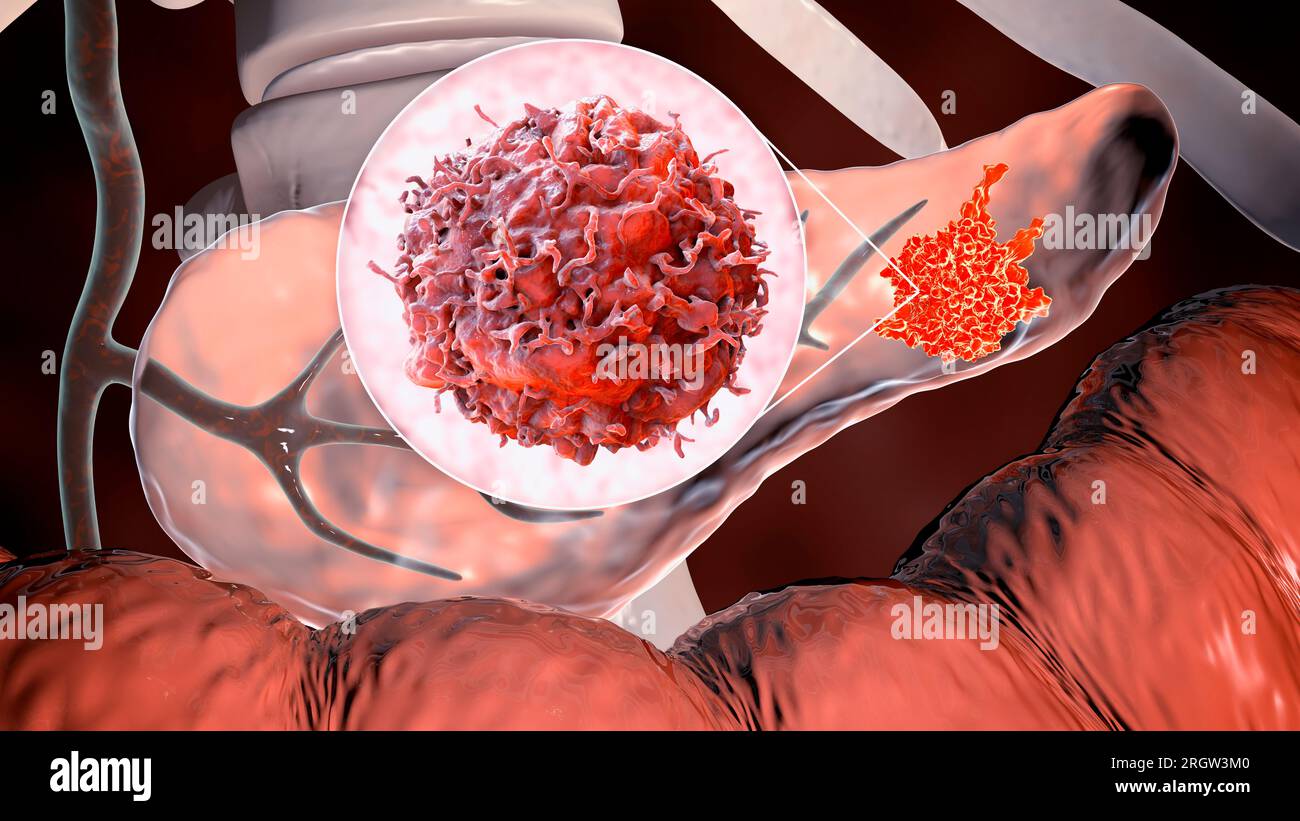 Cancro pancreatico, illustrazione Foto Stock