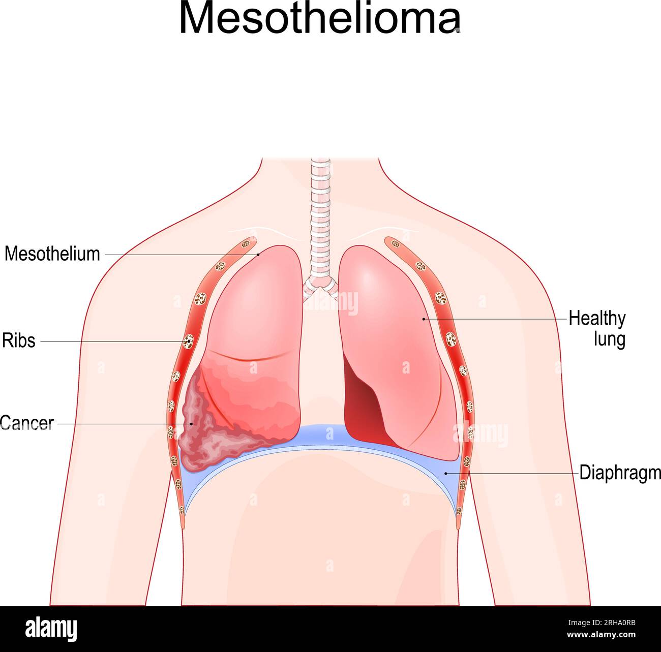 mesotelioma. Tumore maligno del polmone dopo esposizione all'amianto. Illustrazione vettoriale Illustrazione Vettoriale