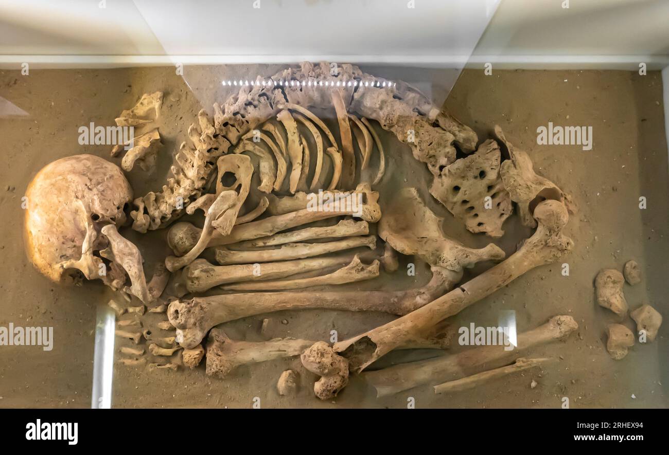 Sepoltura precoce di Dilmun che mostra un caso estremo di fluorosi scheletrica - Cimitero Karzakkan scavi del Bahraini nel 1983 Foto Stock
