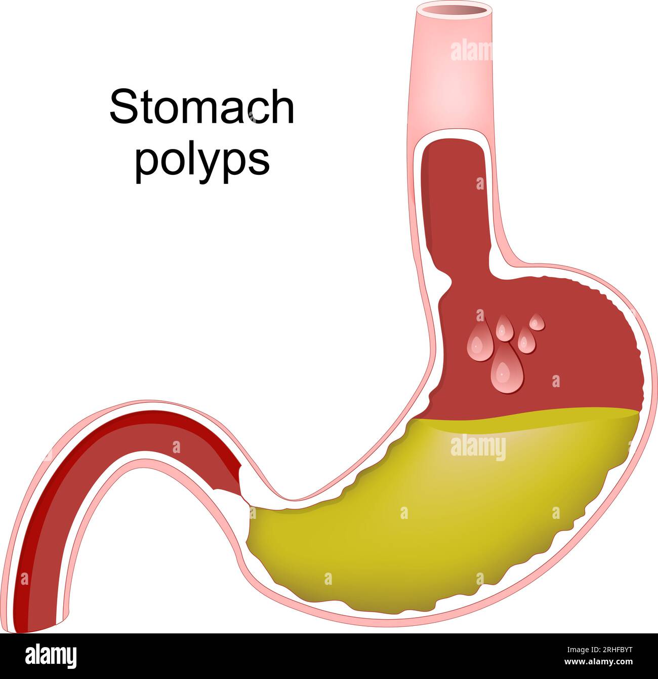 Polipi dello stomaco. Sezione trasversale dello stomaco umano con polipi gastrici. Iperplasia del rivestimento gastrico. Infezione batterica causata da Helicobacter pylori. Illustrazione Vettoriale