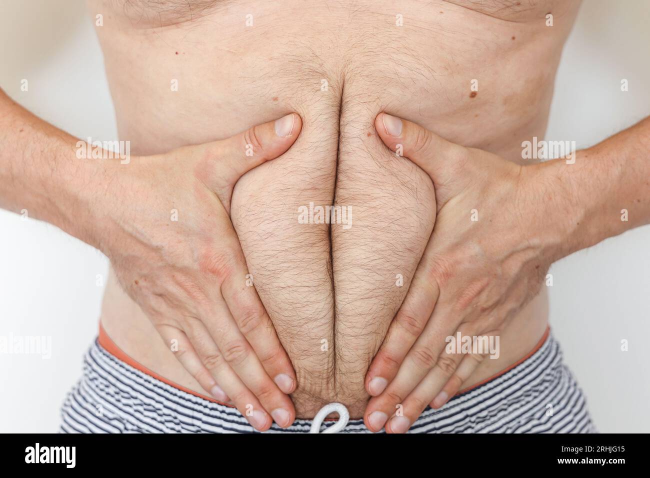 L'uomo obesità irriconoscibile tocca il tessuto adiposo e la linea della cintura del ventre della cellulite che soffre di peso extra. Concetto di mangiare malsano e stile di vita, salute pr Foto Stock