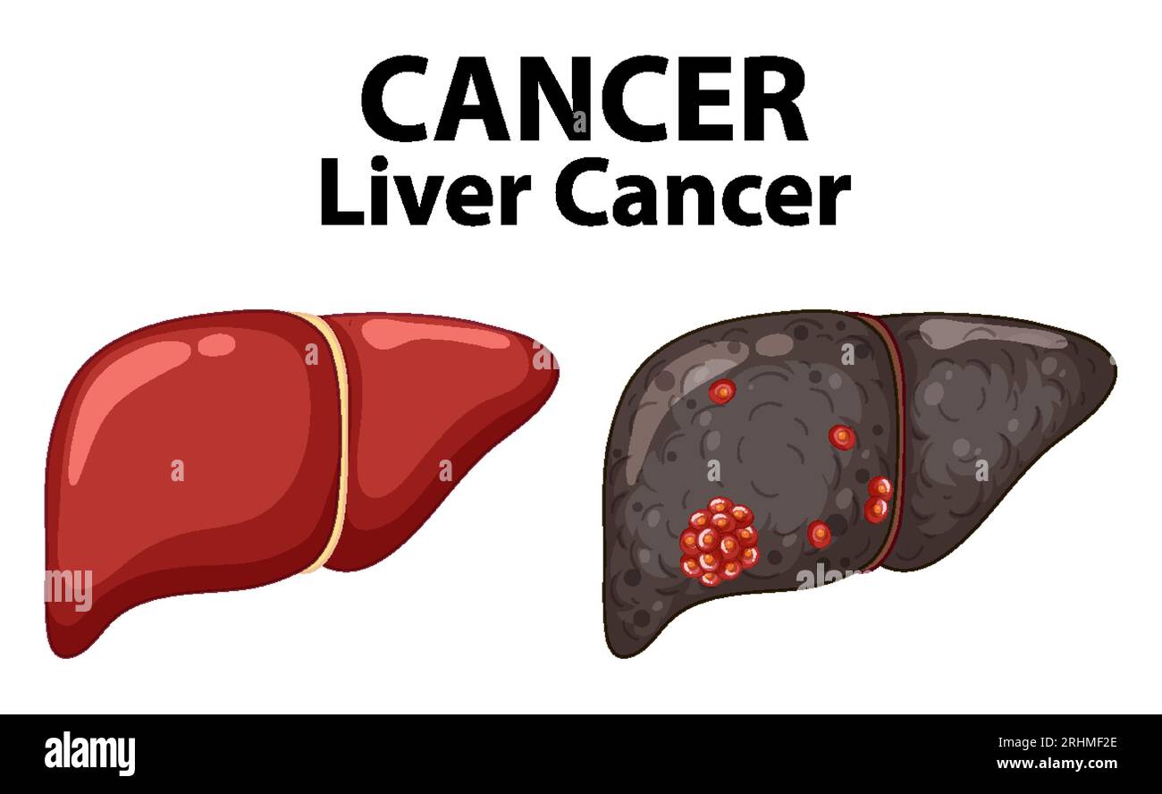 Infografica che illustra l'anatomia delle cellule tumorali epatiche Illustrazione Vettoriale