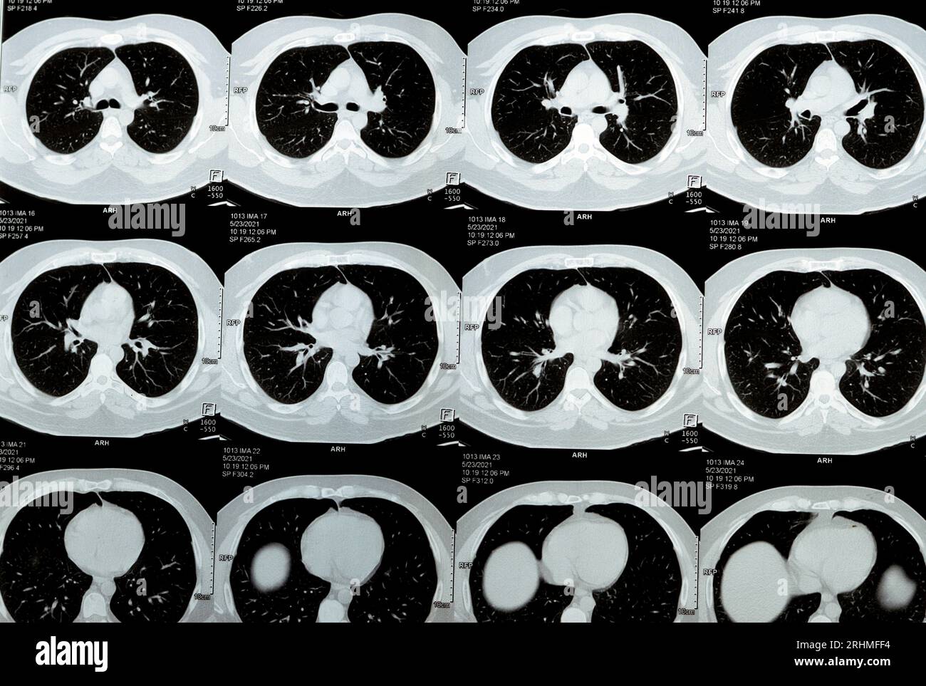 Scansione TC multistrato del torace che mostra uno studio normale, un aspetto normale dei polmoni, parenchima, vascolarizzazione polmonare, strutture mediastiniche, no Foto Stock
