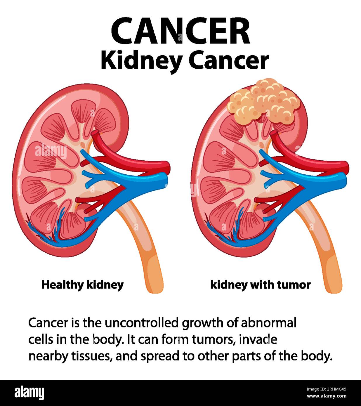 Infografica che illustra la crescita anormale delle cellule nei reni che portano al cancro Illustrazione Vettoriale