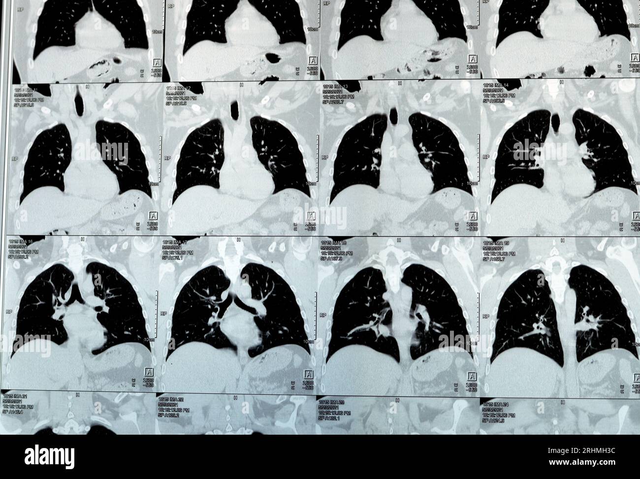 Scansione TC multistrato del torace che mostra uno studio normale, un aspetto normale dei polmoni, parenchima, vascolarizzazione polmonare, strutture mediastiniche, no Foto Stock