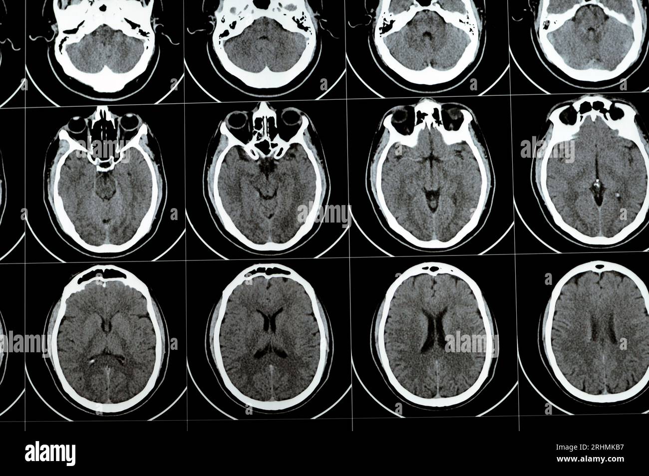 Scansione TC multistrato del cervello che mostra un grande tronco cerebrale e un ematoma semiovale centrale destro, normali strutture della fossa posteriore, dimensioni normali della ventilazione Foto Stock