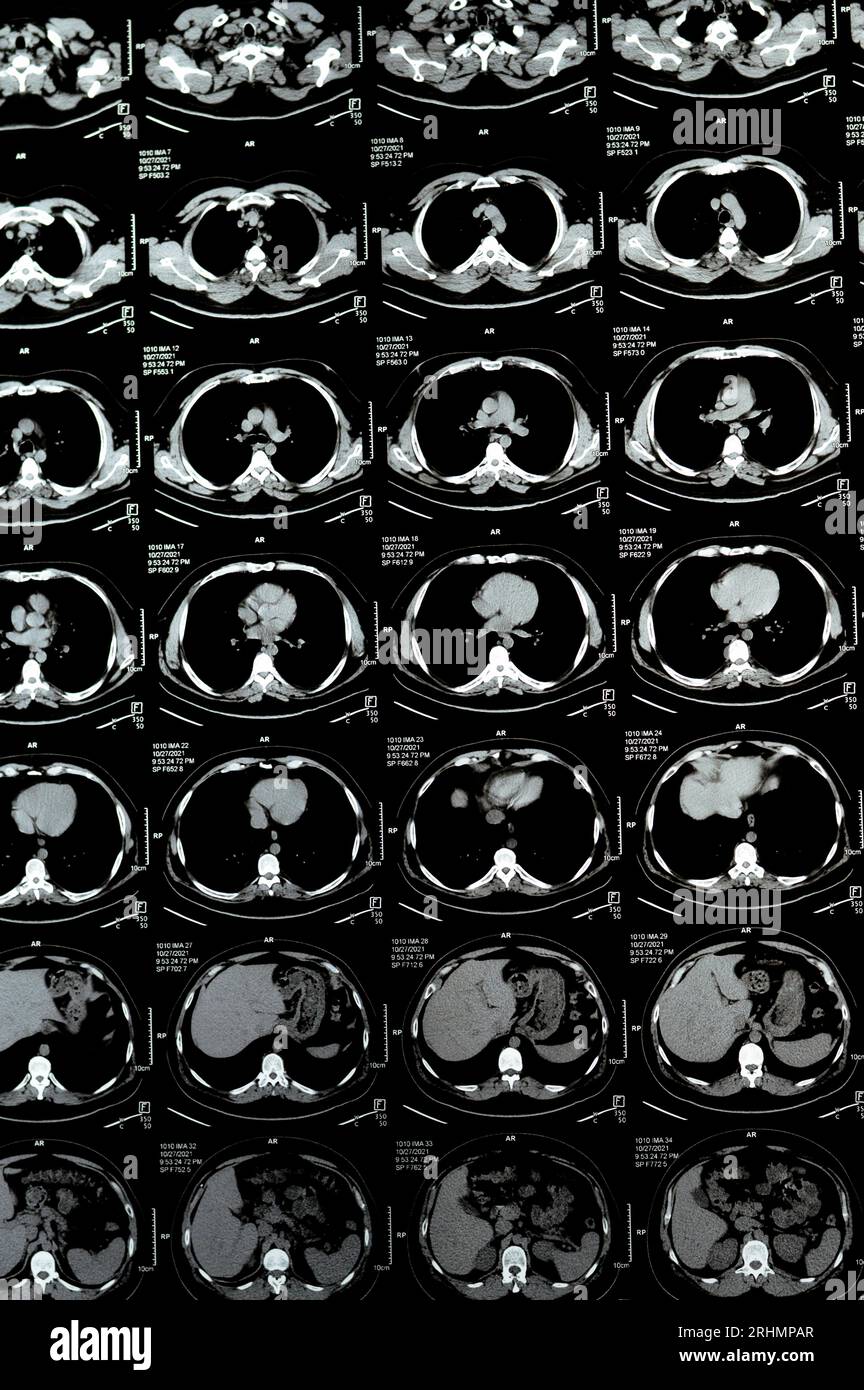Scansione TC multistrato del torace che mostra uno studio normale, un aspetto normale dei polmoni, parenchima, vascolarizzazione polmonare, strutture mediastiniche, no Foto Stock