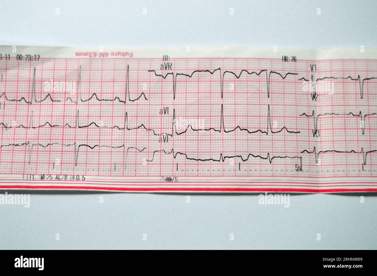 Un ECG elettrocardiografico, una cartella che estrae l'elettricità del cuore e fornisce un'idea delle condizioni cardiache e del ritmo, escludendo qualsiasi Foto Stock