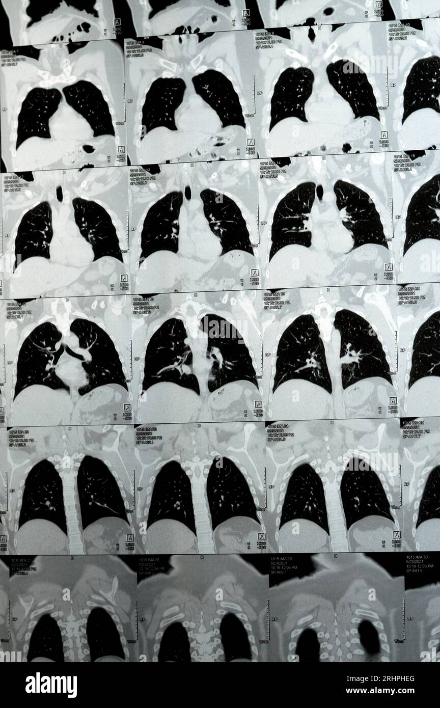 Scansione TC multistrato del torace che mostra uno studio normale, un aspetto normale dei polmoni, parenchima, vascolarizzazione polmonare, strutture mediastiniche, no Foto Stock