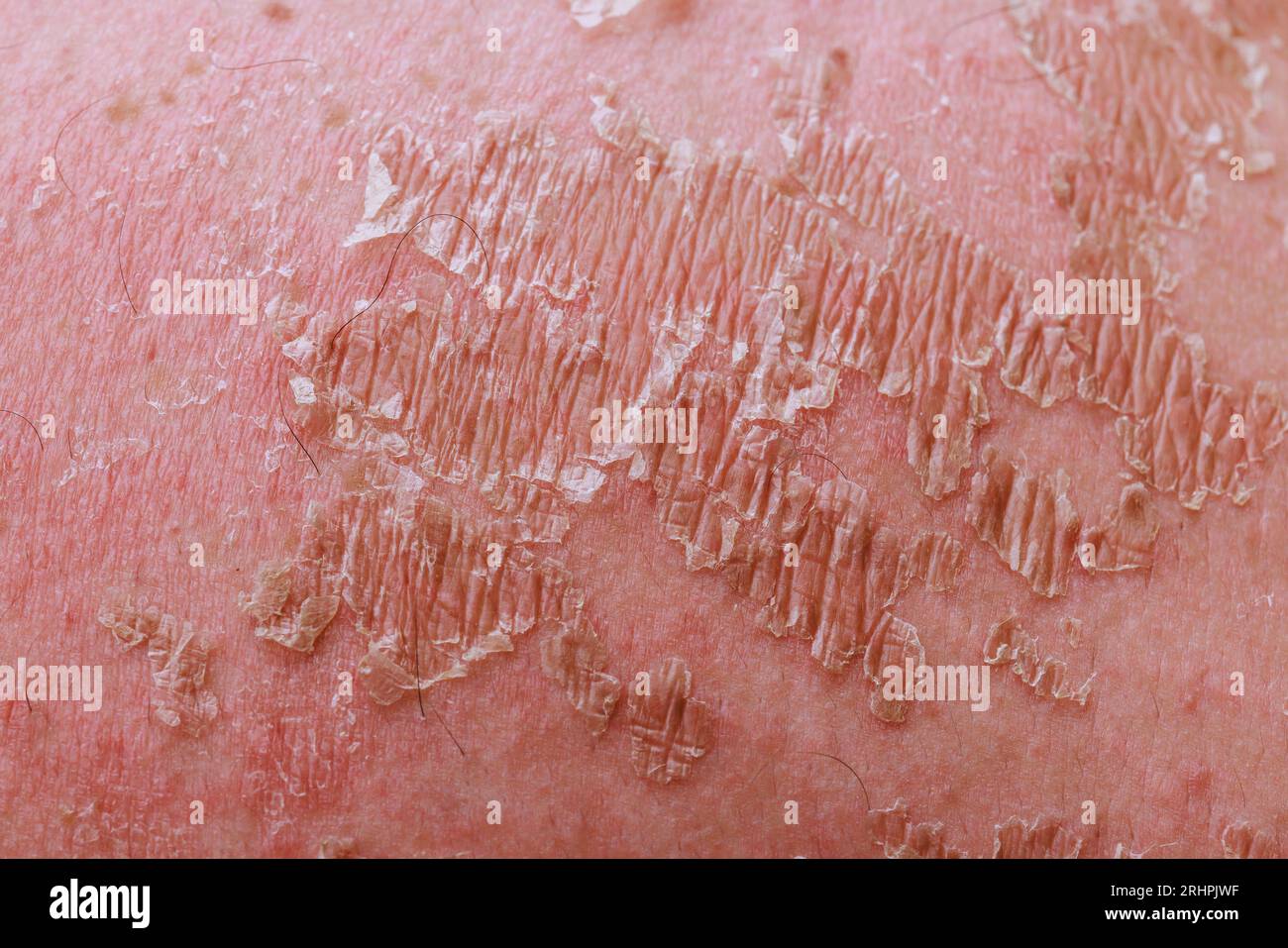 La gestione dell'eczema psoriasico richiede conoscenze specialistiche nel campo della dermatologia. Foto Stock
