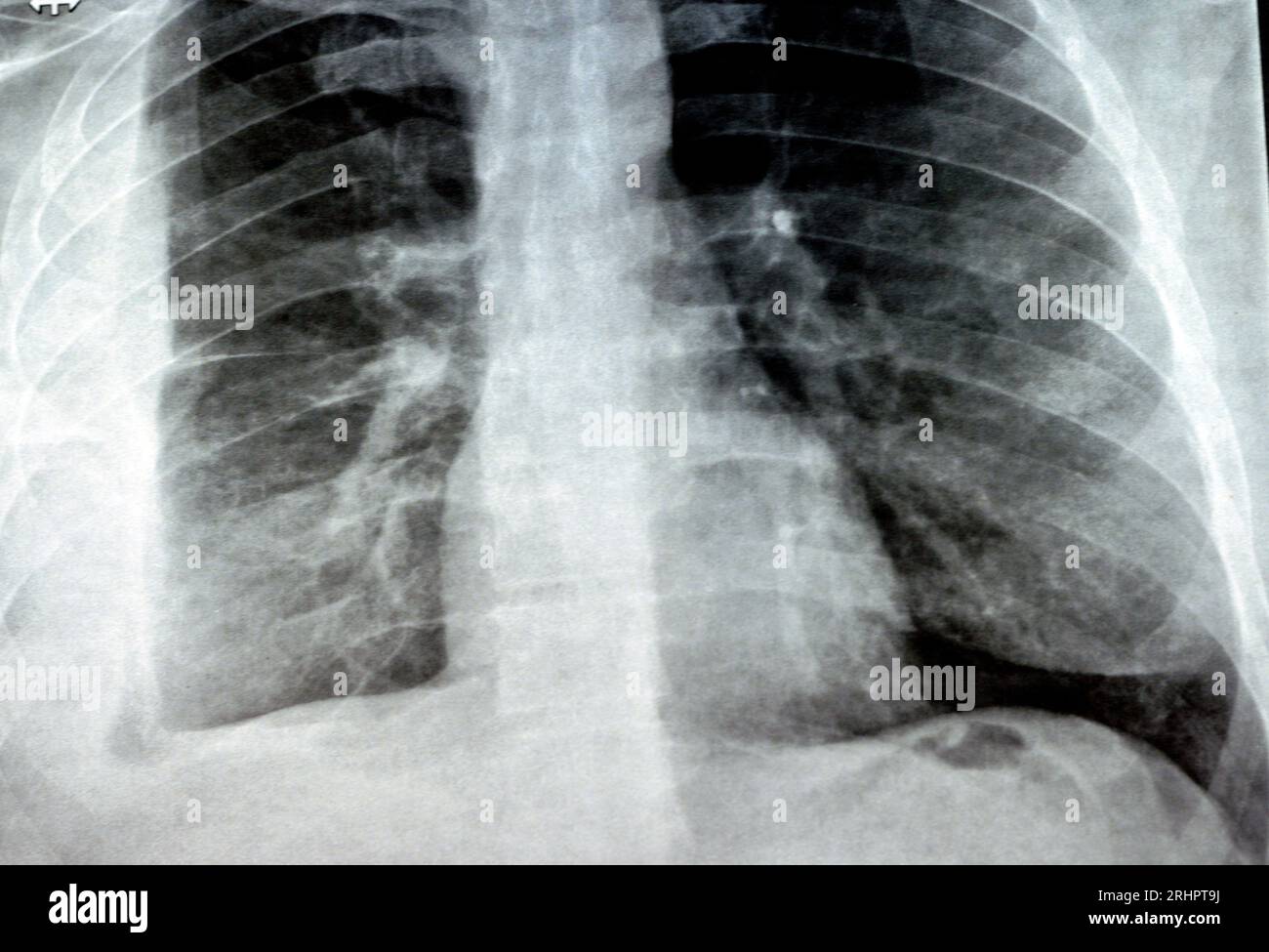 Radiografia semplice per un paziente con polmonite da aspirazione polmone destro, empiema, versamento pleurico dopo l'inserimento di un tubo toracico per drenare l'unità pu Foto Stock