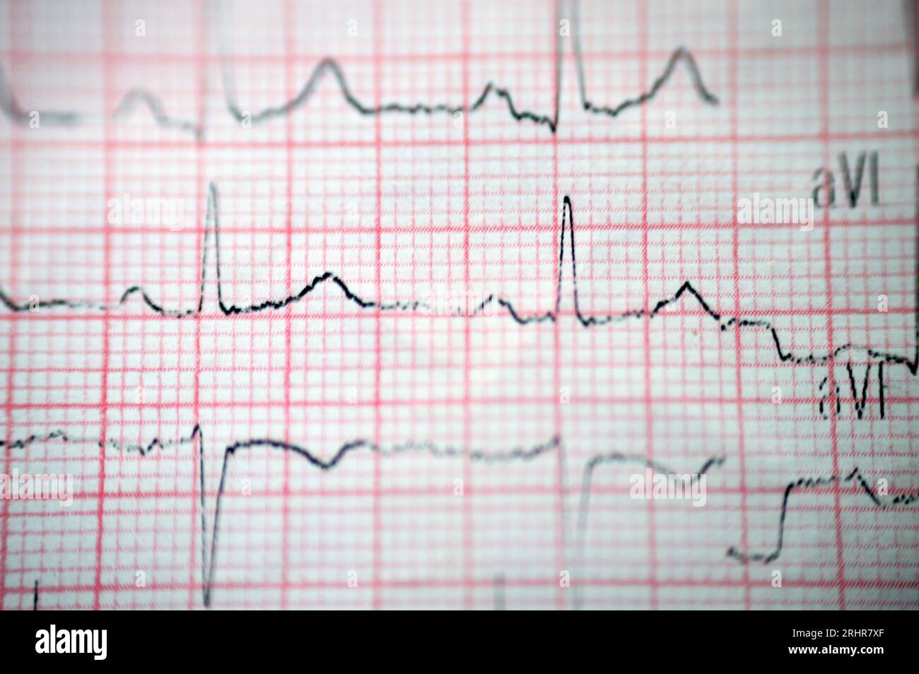 Un ECG elettrocardiografico, una cartella che estrae l'elettricità del cuore e fornisce un'idea delle condizioni cardiache e del ritmo, escludendo qualsiasi Foto Stock