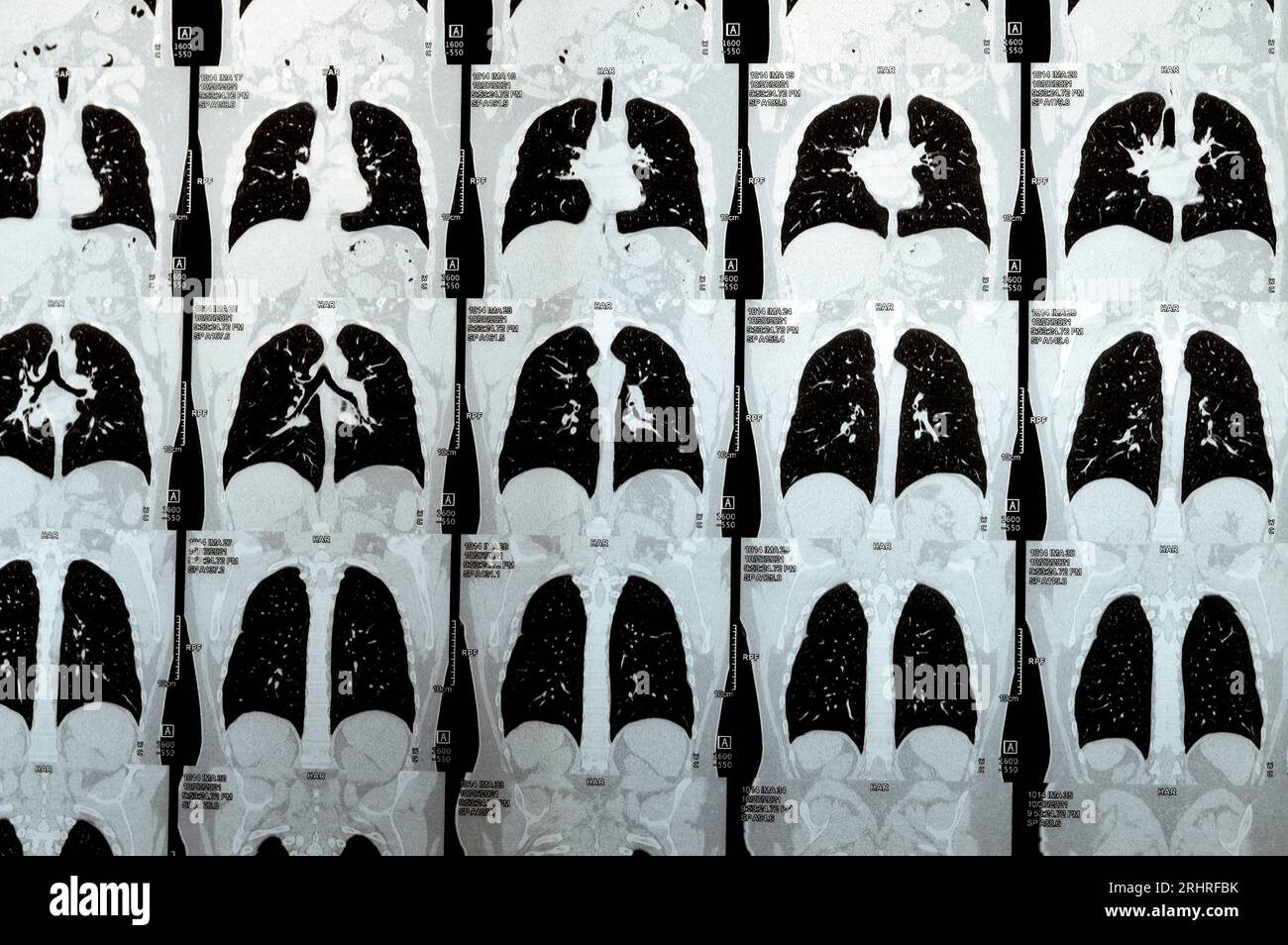 Scansione TC multistrato del torace che mostra uno studio normale, un aspetto normale dei polmoni, parenchima, vascolarizzazione polmonare, strutture mediastiniche, no Foto Stock