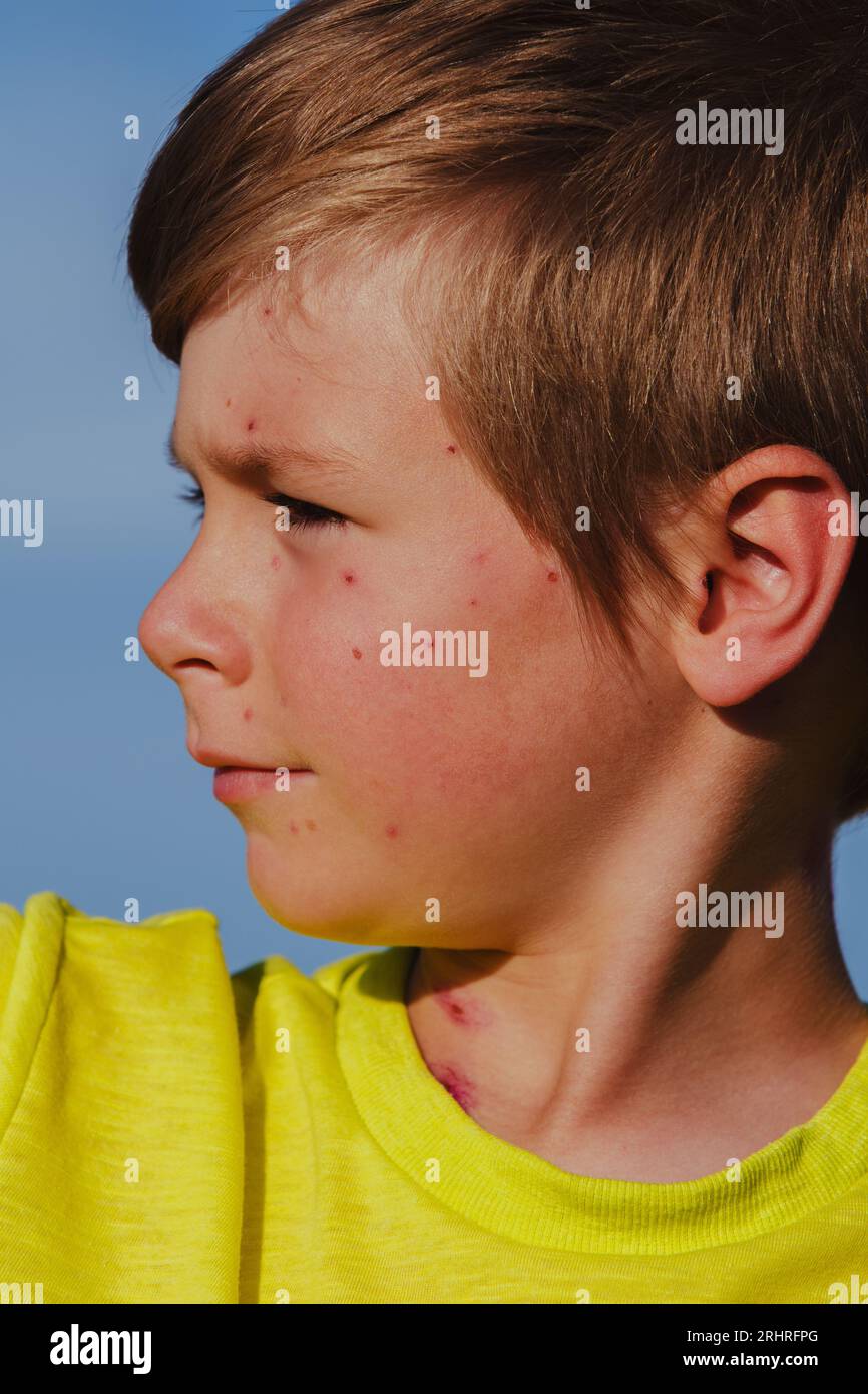 Ritratto all'aperto di un ragazzo con varicella Foto Stock