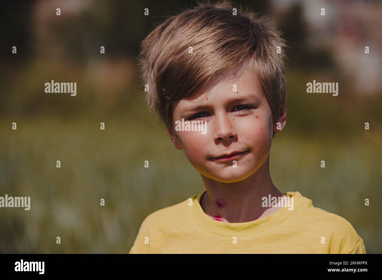 Ritratto all'aperto di un ragazzo con varicella Foto Stock