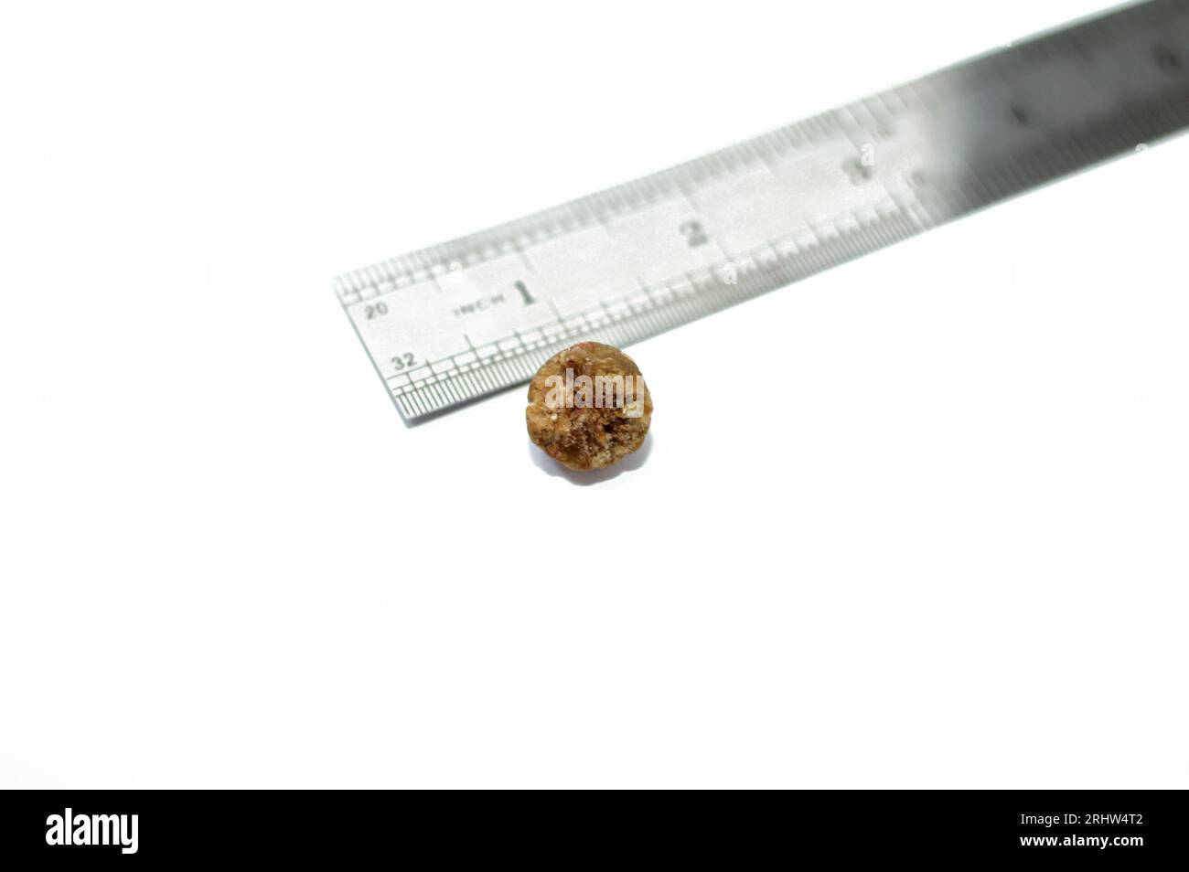 Calcoli biliari grandi rimossi chirurgicamente dopo colecistectomia laparoscopica, calcoli biliari sono depositi induriti di liquido digestivo che possono formarsi in colecisti Foto Stock