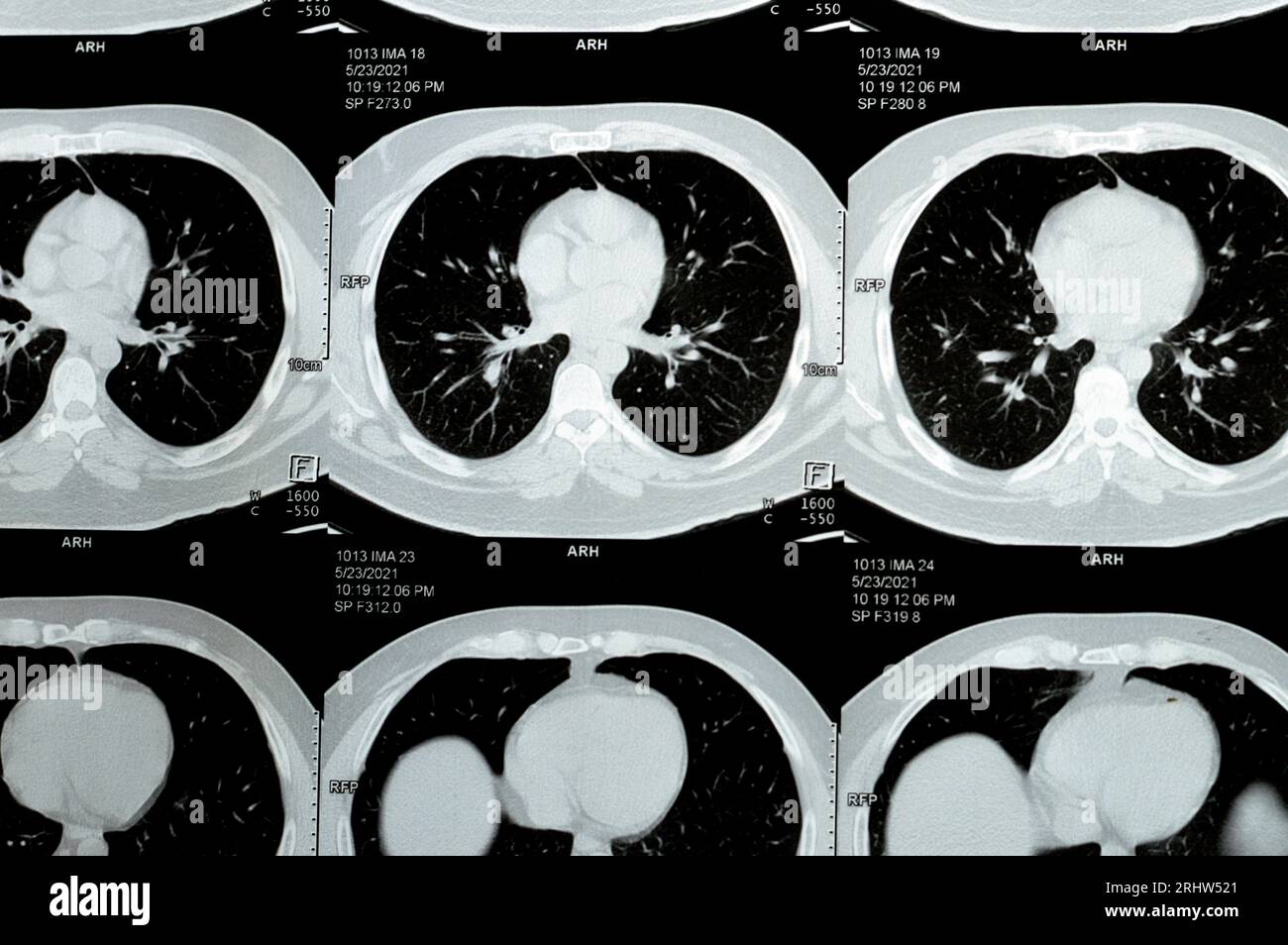 Scansione TC multistrato del torace che mostra uno studio normale, un aspetto normale dei polmoni, parenchima, vascolarizzazione polmonare, strutture mediastiniche, no Foto Stock