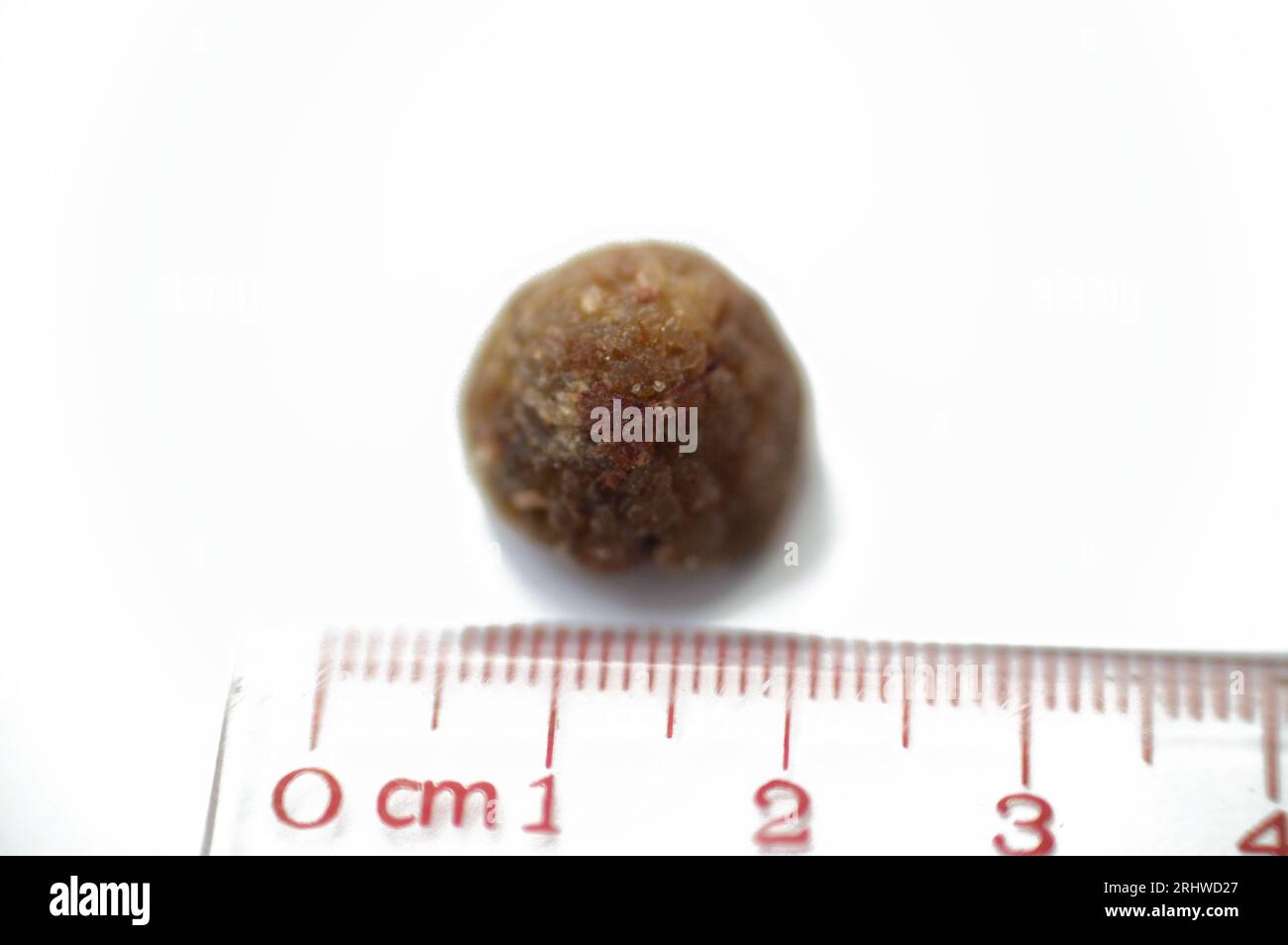 Calcoli biliari grandi rimossi chirurgicamente dopo colecistectomia laparoscopica, calcoli biliari sono depositi induriti di liquido digestivo che possono formarsi in colecisti Foto Stock