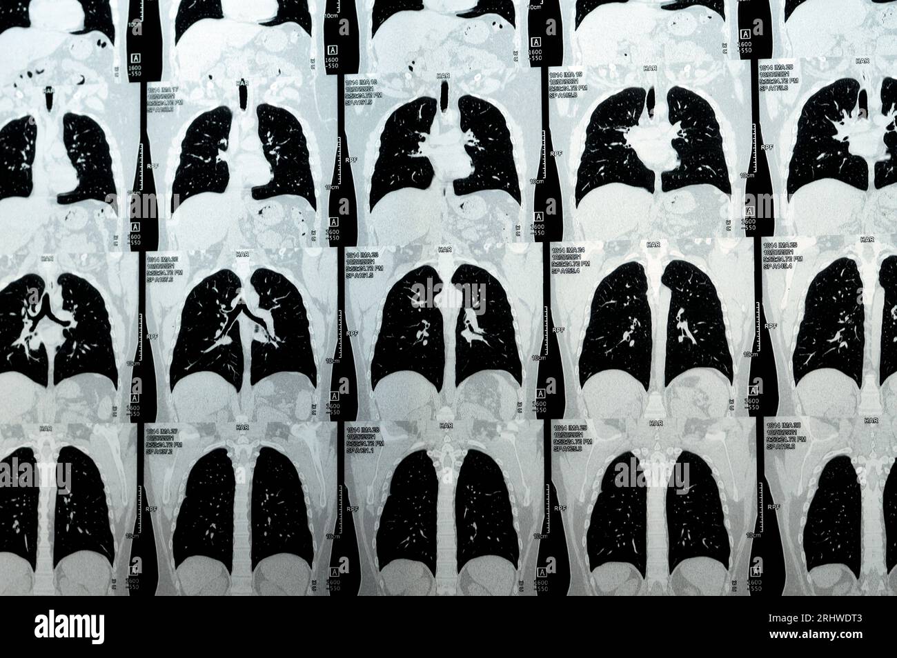 Scansione TC multistrato del torace che mostra uno studio normale, un aspetto normale dei polmoni, parenchima, vascolarizzazione polmonare, strutture mediastiniche, no Foto Stock