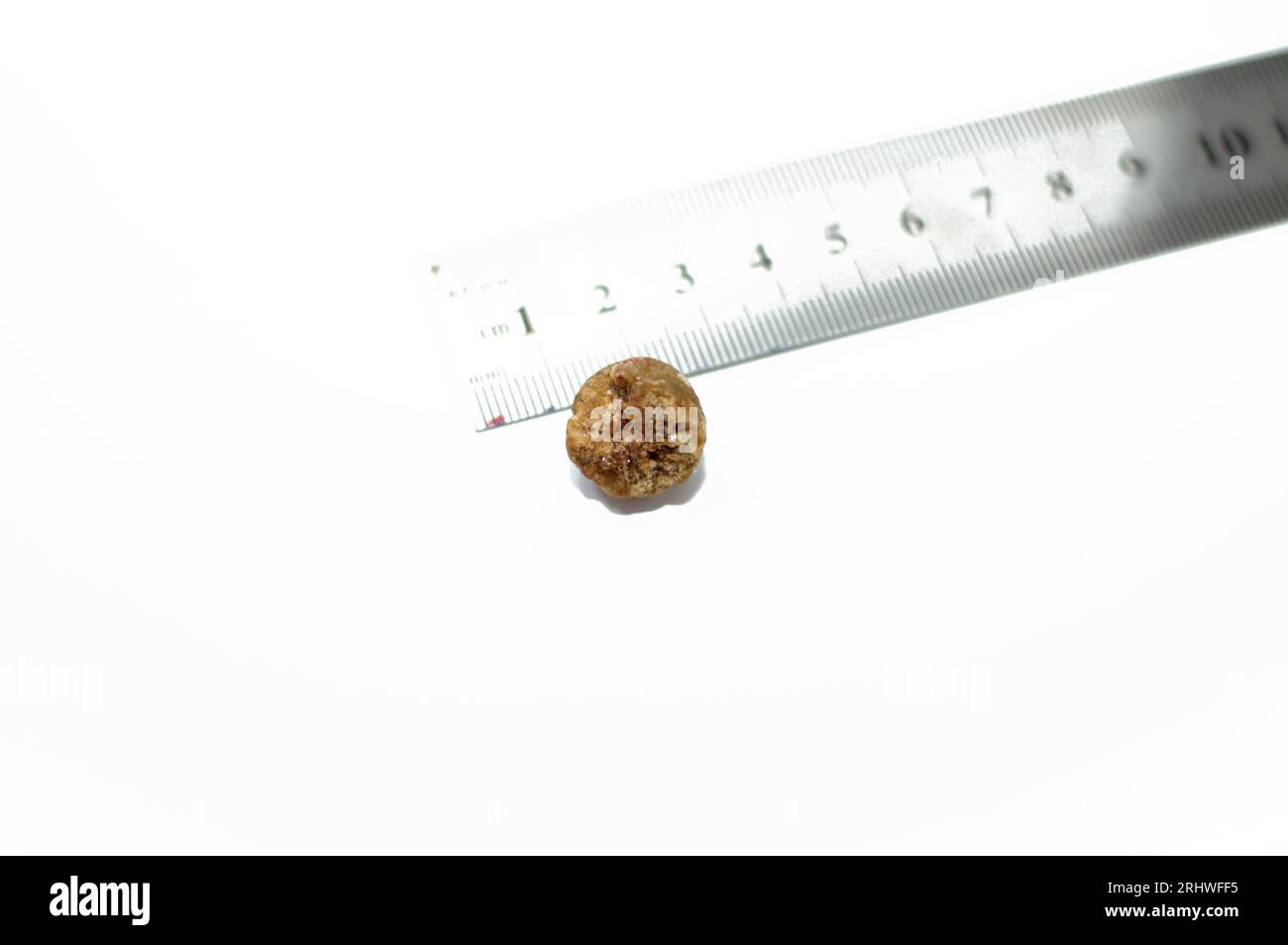 Calcoli biliari grandi rimossi chirurgicamente dopo colecistectomia laparoscopica, calcoli biliari sono depositi induriti di liquido digestivo che possono formarsi in colecisti Foto Stock