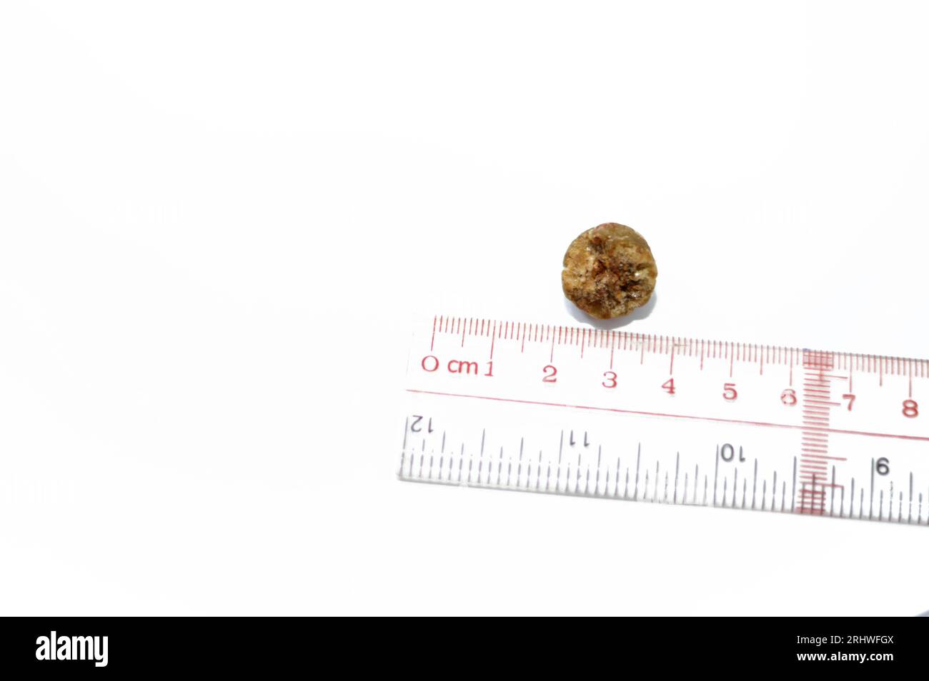 Calcoli biliari grandi rimossi chirurgicamente dopo colecistectomia laparoscopica, calcoli biliari sono depositi induriti di liquido digestivo che possono formarsi in colecisti Foto Stock