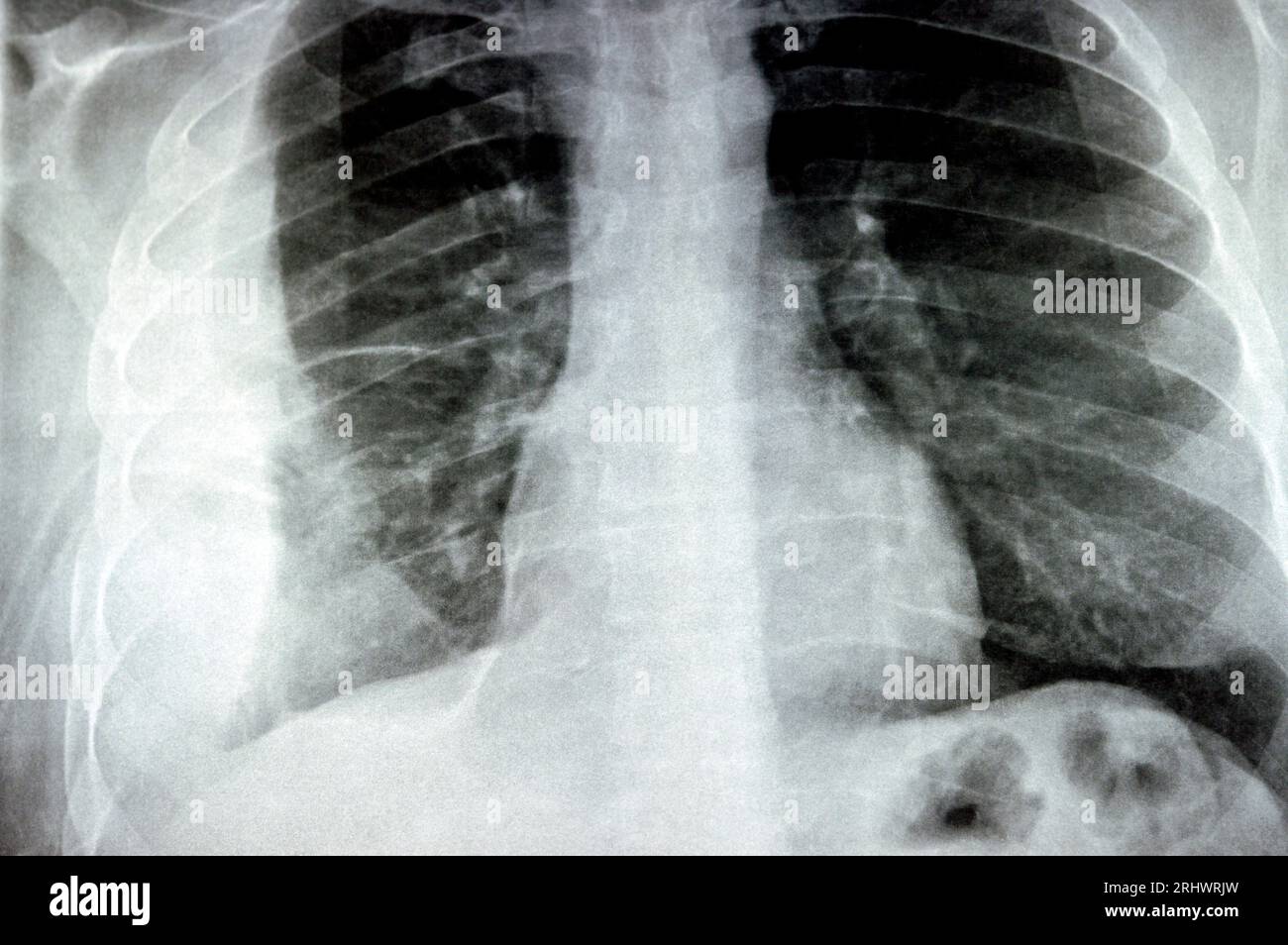 Radiografia semplice per un paziente con polmonite da aspirazione polmone destro, empiema, versamento pleurico dopo l'inserimento di un tubo toracico per drenare l'unità pu Foto Stock
