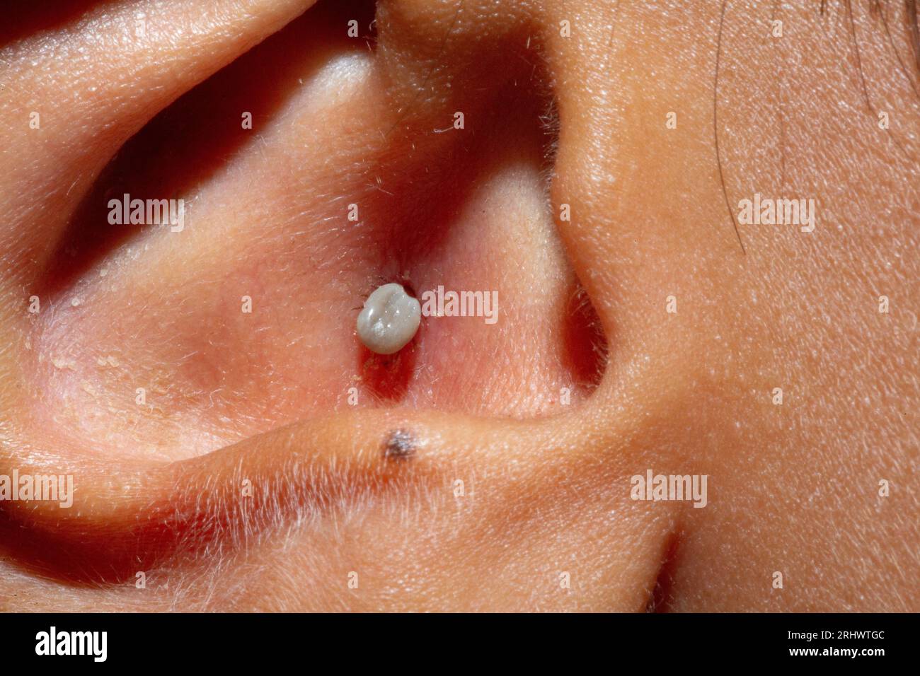 Rovigo, Italia - 12 agosto 2023: Fotografia macro dell'orecchio di un bambino parassita da una zecca. Parassita che succhia sangue all'interno dell'orecchio umano. Foto Stock