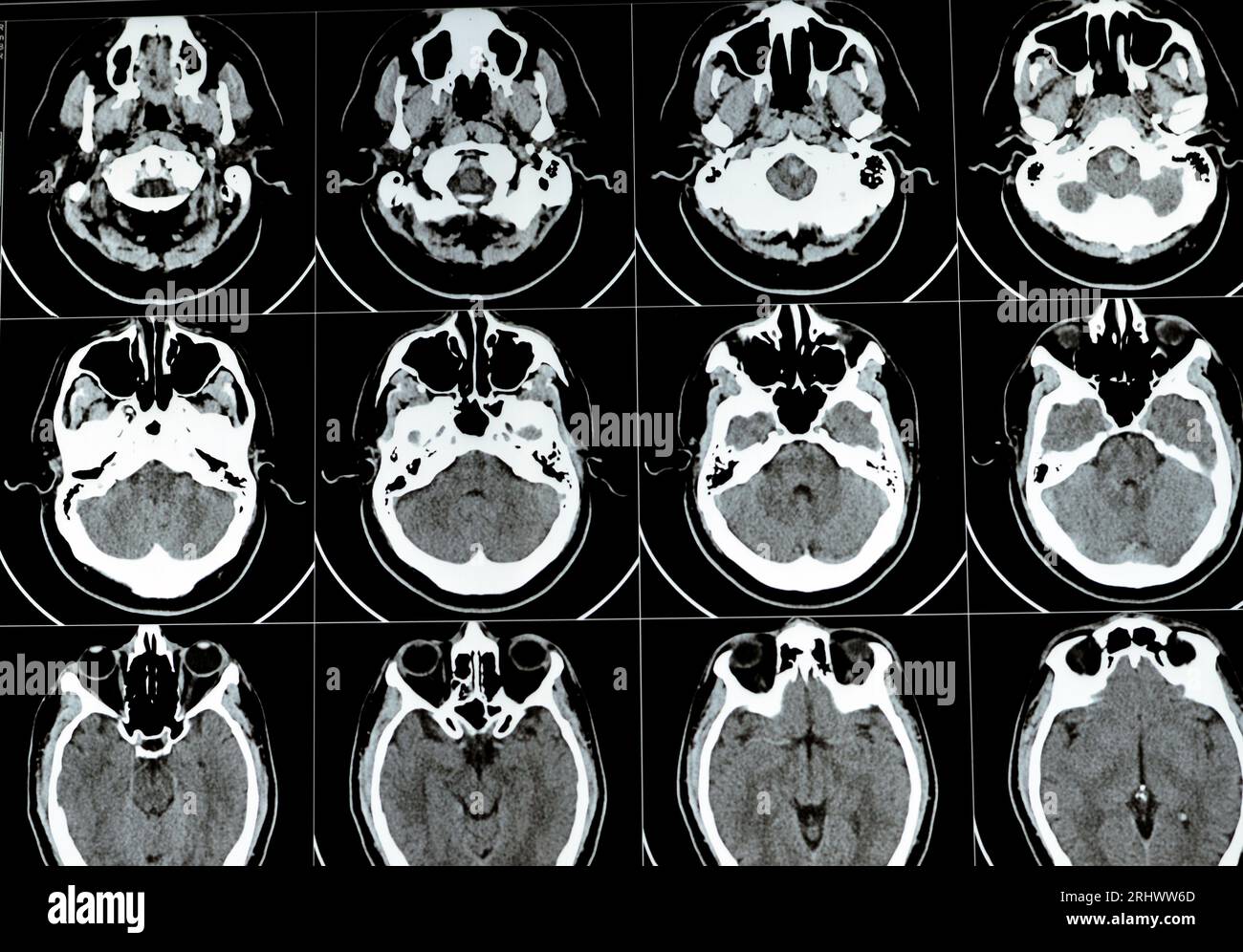 Scansione TC multistrato del cervello che mostra un grande tronco cerebrale e un ematoma semiovale centrale destro, normali strutture della fossa posteriore, dimensioni normali della ventilazione Foto Stock