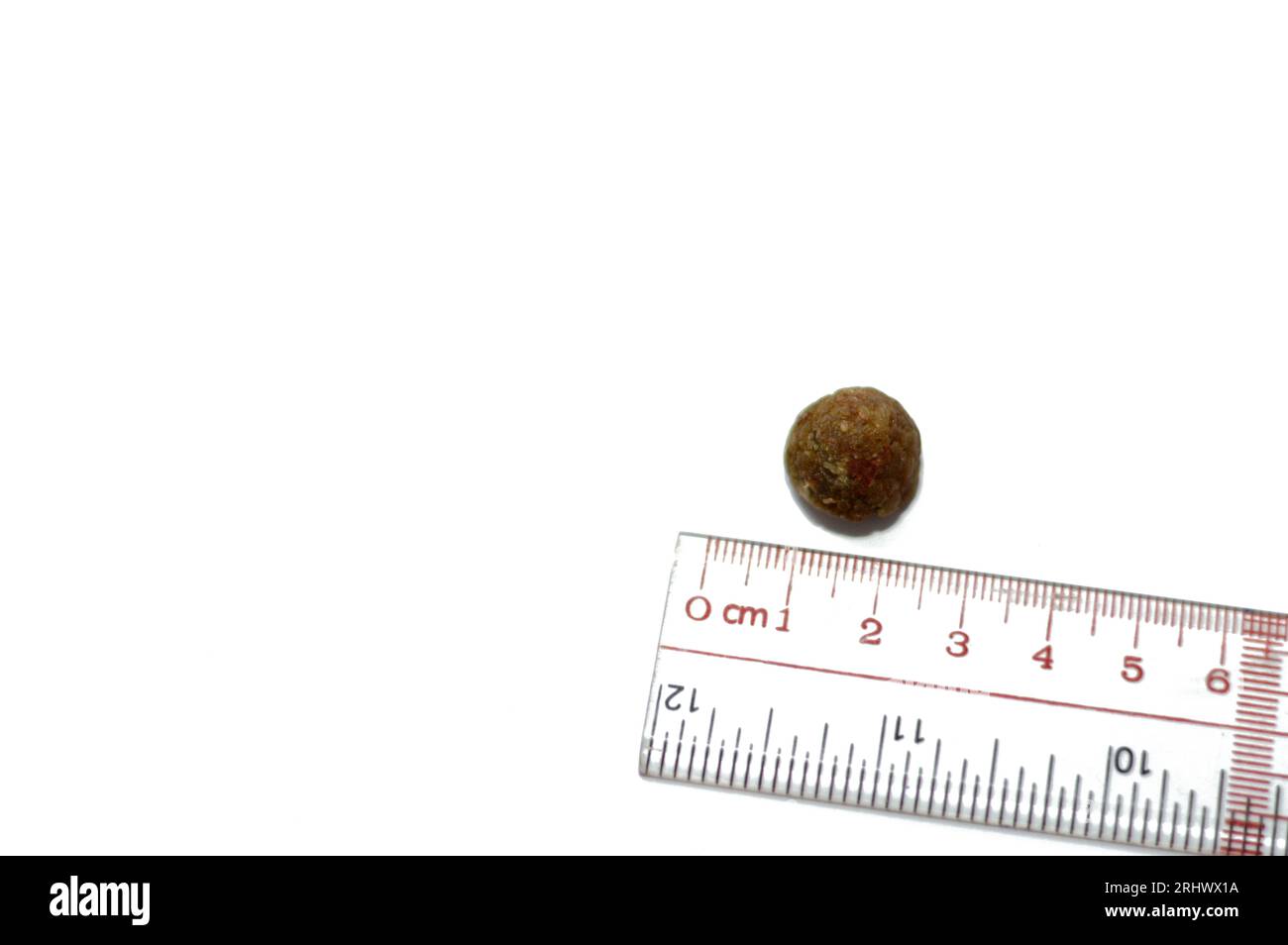 Calcoli biliari grandi rimossi chirurgicamente dopo colecistectomia laparoscopica, calcoli biliari sono depositi induriti di liquido digestivo che possono formarsi in colecisti Foto Stock