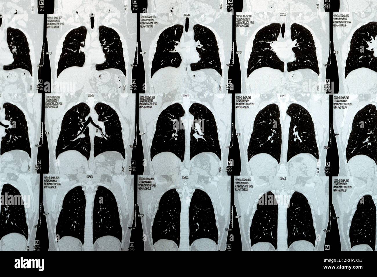 Scansione TC multistrato del torace che mostra uno studio normale, un aspetto normale dei polmoni, parenchima, vascolarizzazione polmonare, strutture mediastiniche, no Foto Stock