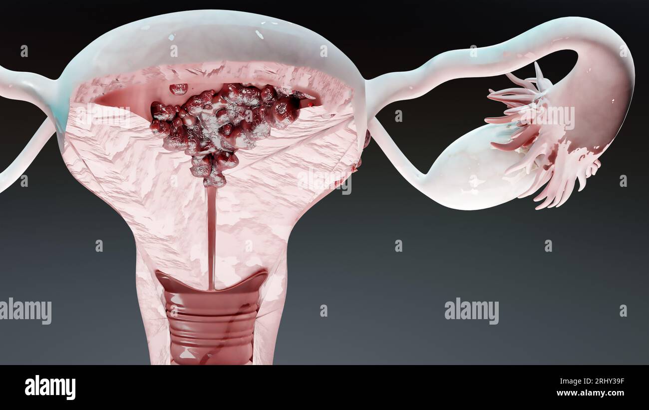 Tumore maligno dell'utero, anatomia femminile dell'utero, sistema riproduttivo, cellule tumorali, cisti ovariche, cancro cervicale, cellule in crescita, malattia ginecologica Foto Stock