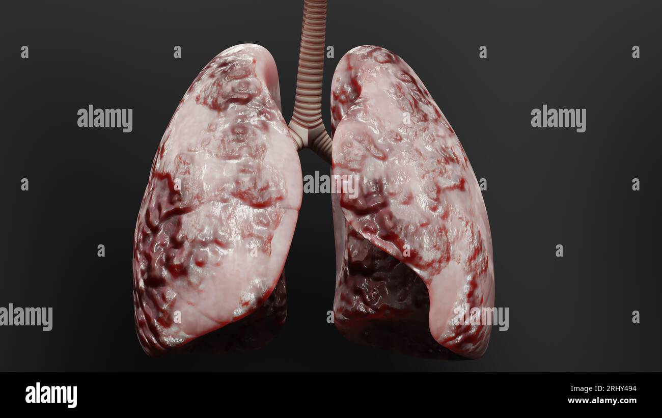 Polmonite malattia, polmoni sani e polmoni malattia, cancro polmonare umano, fumatori di sigaretta malattia polmonare, tumori maligni cancerosi in crescita e spreadina Foto Stock