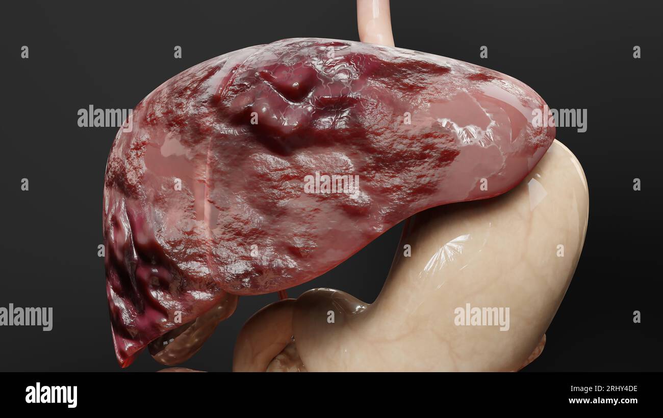 Cancro del fegato dell'organo digestivo, epatite cirrosi tumore maligno, insufficienza epatica, cellule in crescita, duplicazione, fibrosi, cirrosi, CA epatocellulare Foto Stock