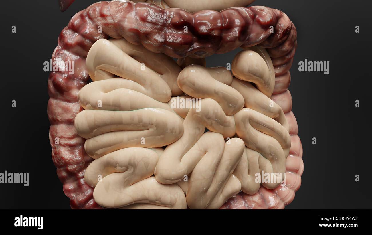 Cancro intestinale o tumore colorettale, cancro del colon, malattia infiammatoria intestinale, dolore intestinale, celiaco, infezioni, duplicazione, celle in espansione Foto Stock