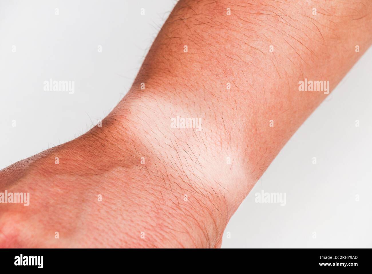 Primo piano del polso di un braccio umano irriconoscibile con un marchio abbronzato o dopo aver preso il sole durante l'estate su sfondo bianco. Foto Stock