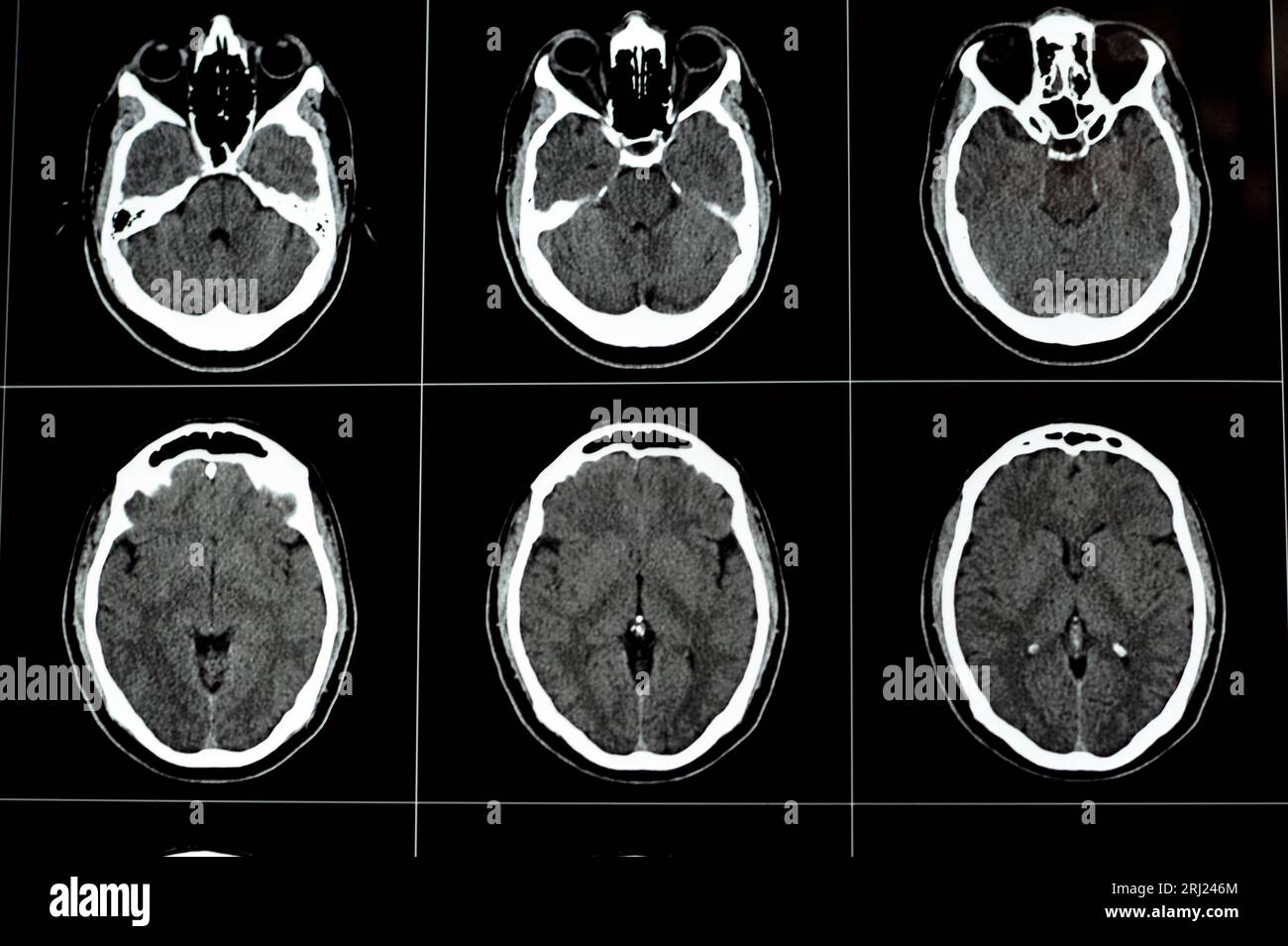 Lesione cerebrale immagini e fotografie stock ad alta risoluzione - Alamy