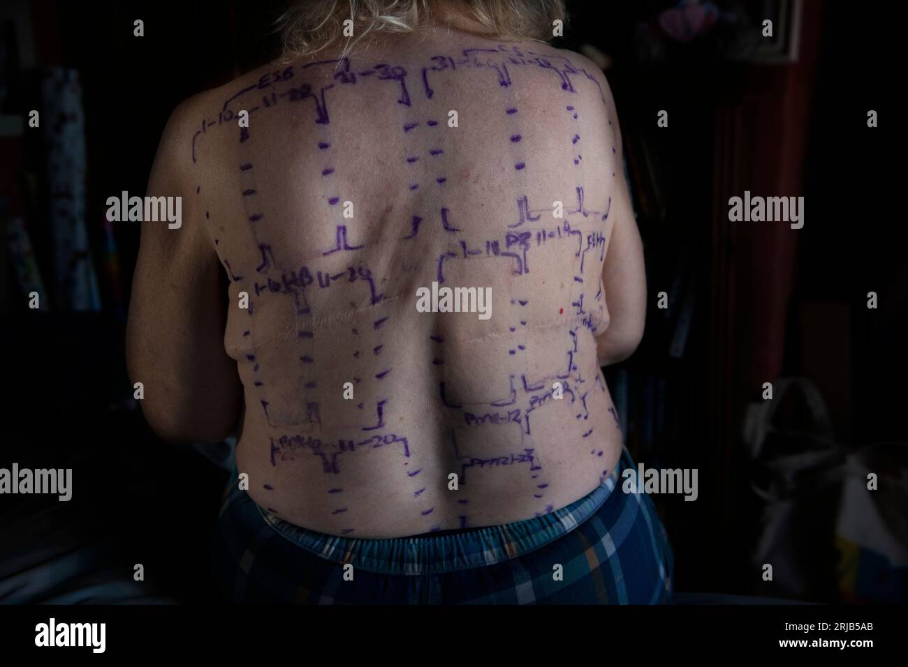 Allergy Patch Testing England Photograph Model Releaed agosto 2023 Un patch test è un metodo diagnostico utilizzato per determinare quali sostanze specifiche cau Foto Stock