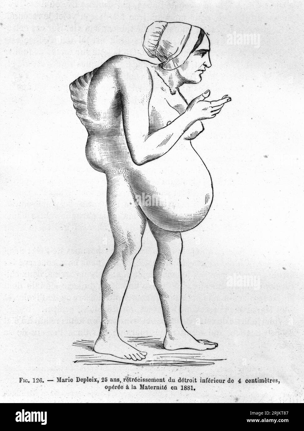 GJA Witkowski, storia del parto. Marie Depleix, 25 anni, restringimento dello stretto inferiore di 4 centimetri operò alla maternità nel 1881. Foto Stock