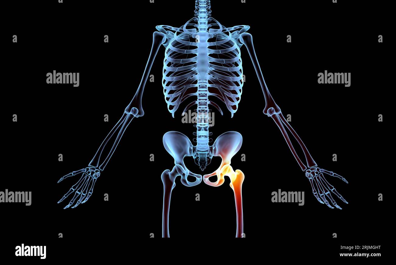 Scheletro radiografico indicante dolore osseo articolare dell'anca Foto Stock