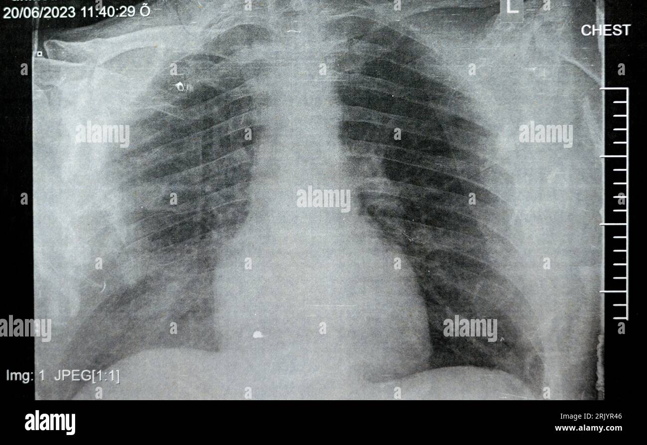 Radiografia toracica semplice che mostra polmonite infettiva da processo polmonare con lato destro versamento para-polmonare minimo, polmonite da aspirazione lato destro Foto Stock