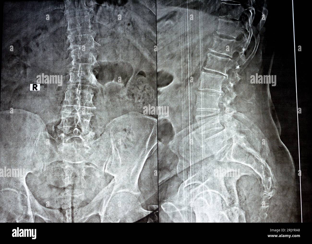 Radiografia semplice della colonna vertebrale lombare nelle viste AP e laterale, labbro osteofitico anteriore marginale delle piastre terminali vertebrali, riduzione del lum inferiore Foto Stock