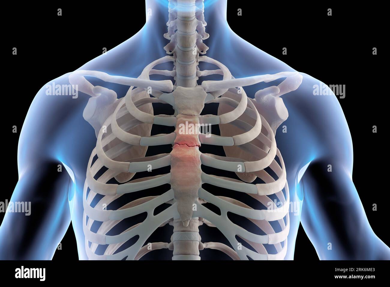 Illustrazione medica 3D dello scheletro con sterno rotto Foto Stock