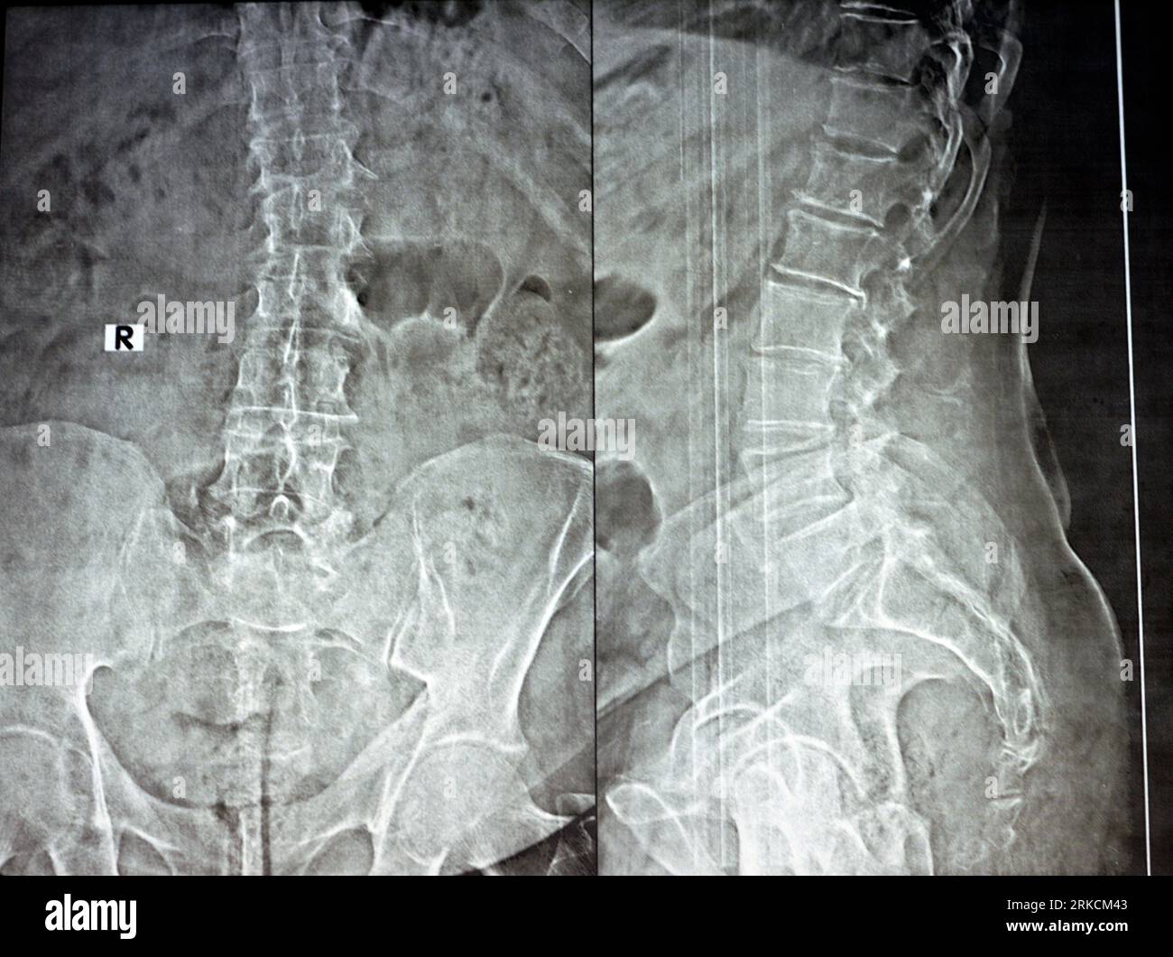 Radiografia semplice della colonna vertebrale lombare nelle viste AP e laterale, labbro osteofitico anteriore marginale delle piastre terminali vertebrali, riduzione del lum inferiore Foto Stock